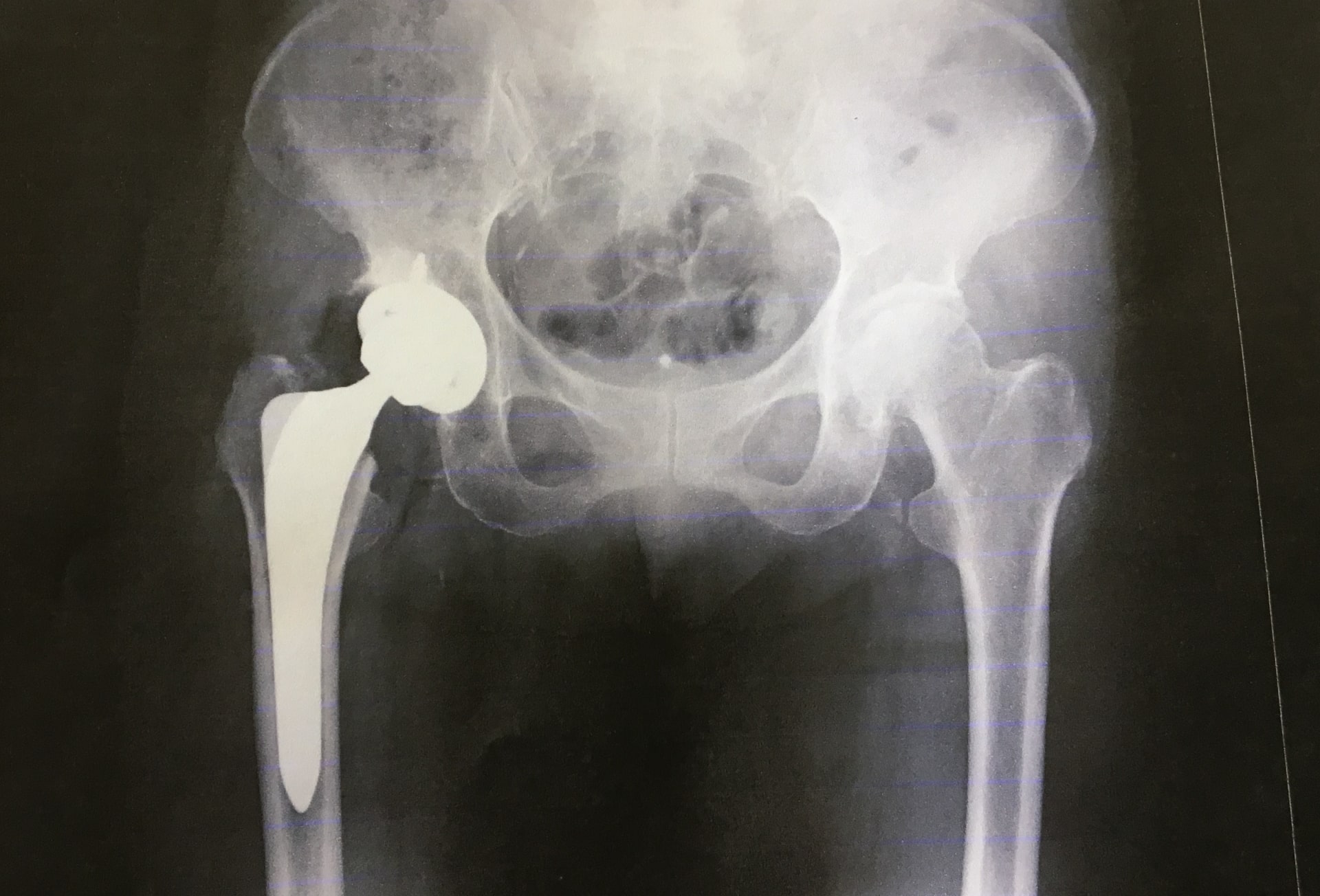 Hip x ray